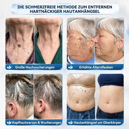 7-Day Skin Tag & Blemish Cream: Painless & Scar-Free High-Quality Blemish Removal Cream