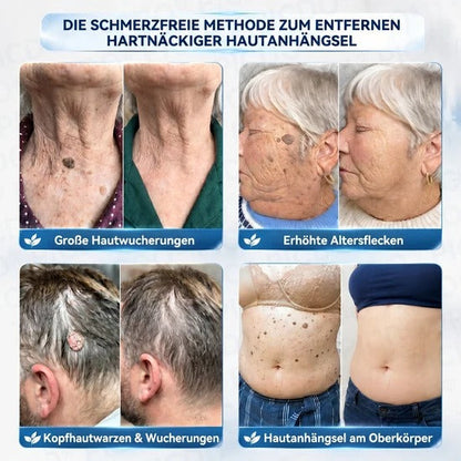 7-Day Skin Tag & Blemish Cream: Painless & Scar-Free High-Quality Blemish Removal Cream