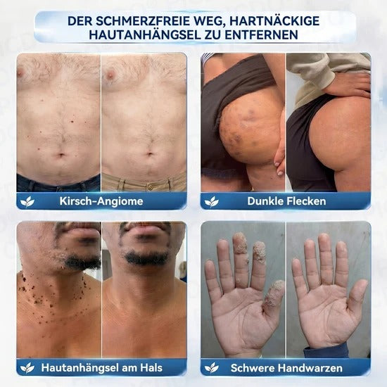 7-Day Skin Tag & Blemish Cream: Painless & Scar-Free High-Quality Blemish Removal Cream