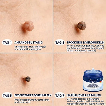 7-Day Skin Tag & Blemish Cream: Painless & Scar-Free High-Quality Blemish Removal Cream